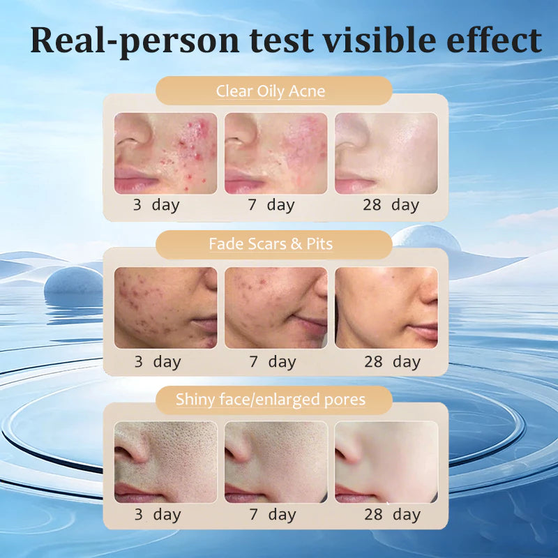 ๐ฟโจ Herbal Acne Scar Removal Cream โจ๐ฟ ( BUY 1 GET 1 FREE )