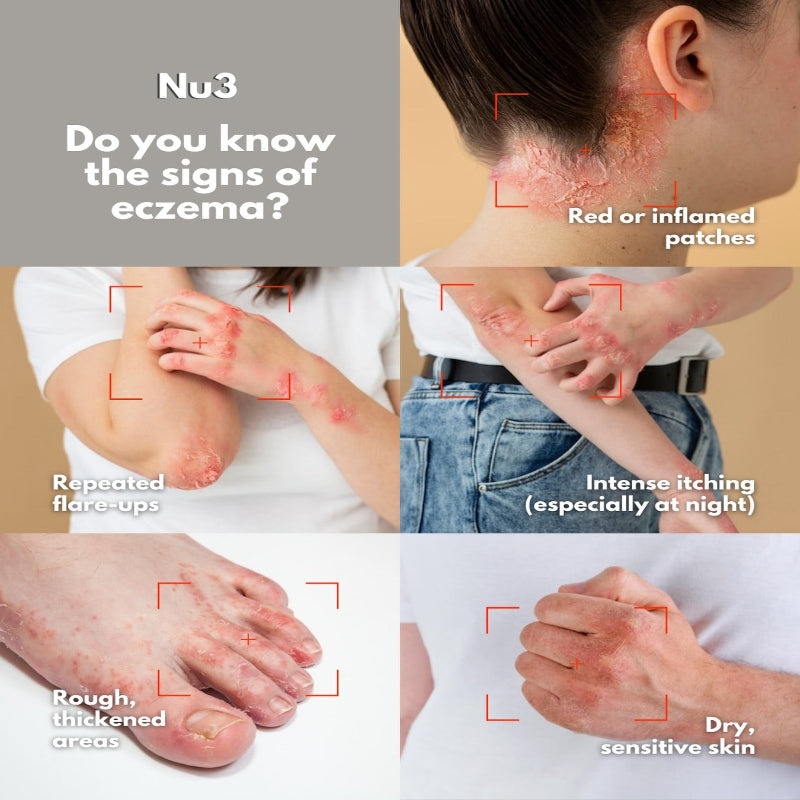 🌿🧴 NU3 EP ANTI-ITCH SOOTHING CREAM 🧴🌿 ( BUY 1 GET 1 FREE )