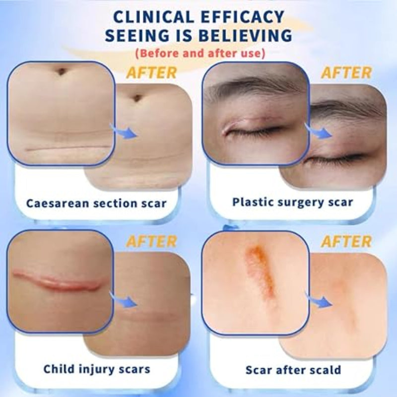 Dermatix Ultra Scar Cream ( BUY 1 GET 1 FREE)