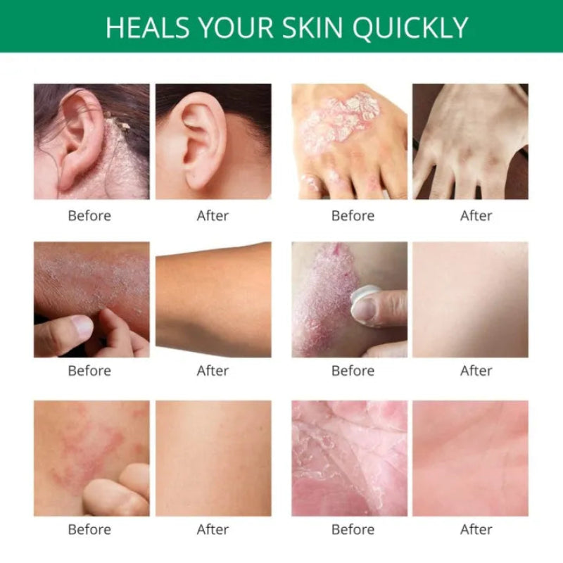 ✨ Psoriasis & Eczema Ointment Cream ✨ ( BUY 1 GET 1 FREE )