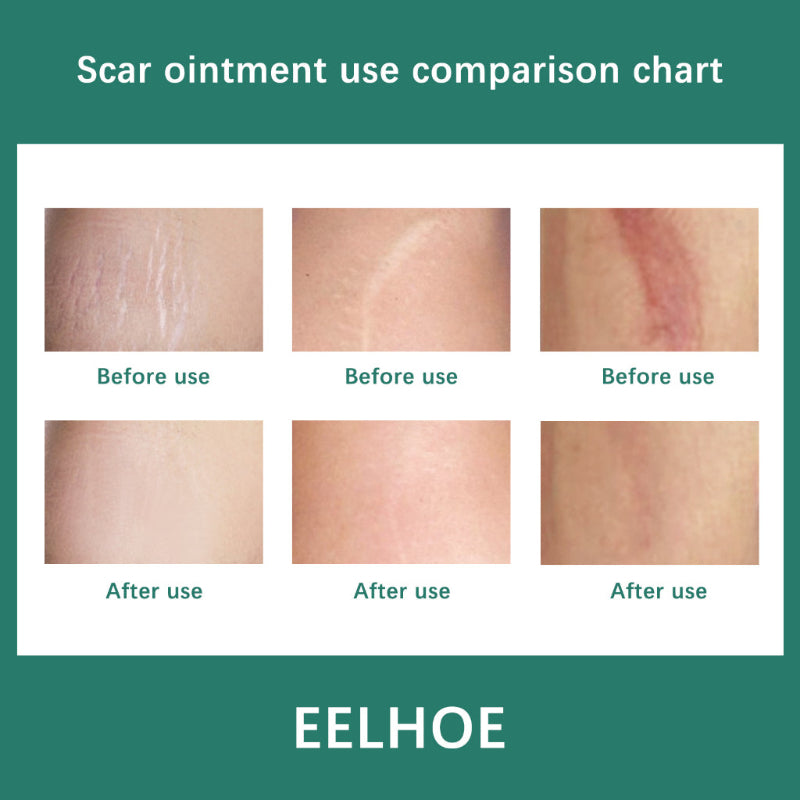 ✨ EELHOE Scar Remove Cream ✨ ( BUY 1 GET 1 FREE )