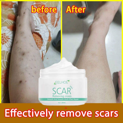 ✨ EELHOE Scar Remove Cream ✨ ( BUY 1 GET 1 FREE )