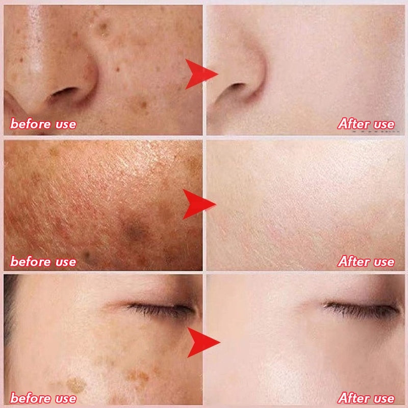 377 Whitening Dark Spots Cream ( BUY 1 GET 1 FREE )
