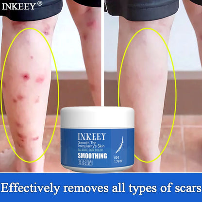 ✨🌿 Inkeey Scar Removal Cream 🌿✨ (BUY 1 GET 1 FREE )