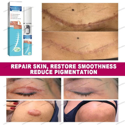 ✨ Laser Scar Removal Pen ✨ ( BUY 1 GET 1 FREE )