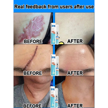 ✨ Laser Scar Removal Pen ✨ ( BUY 1 GET 1 FREE )