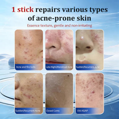 🌿✨ Herbal Acne Scar Removal Cream ✨🌿 ( BUY 1 GET 1 FREE )
