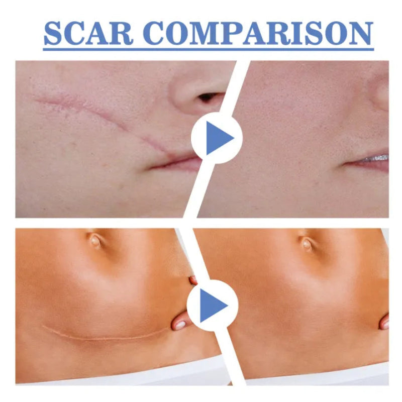 🌟 SOUTH MOON HIGH QUALITY SILICONE SCAR SHEET 🌟 ( BUY 1 GET 1 FREE )