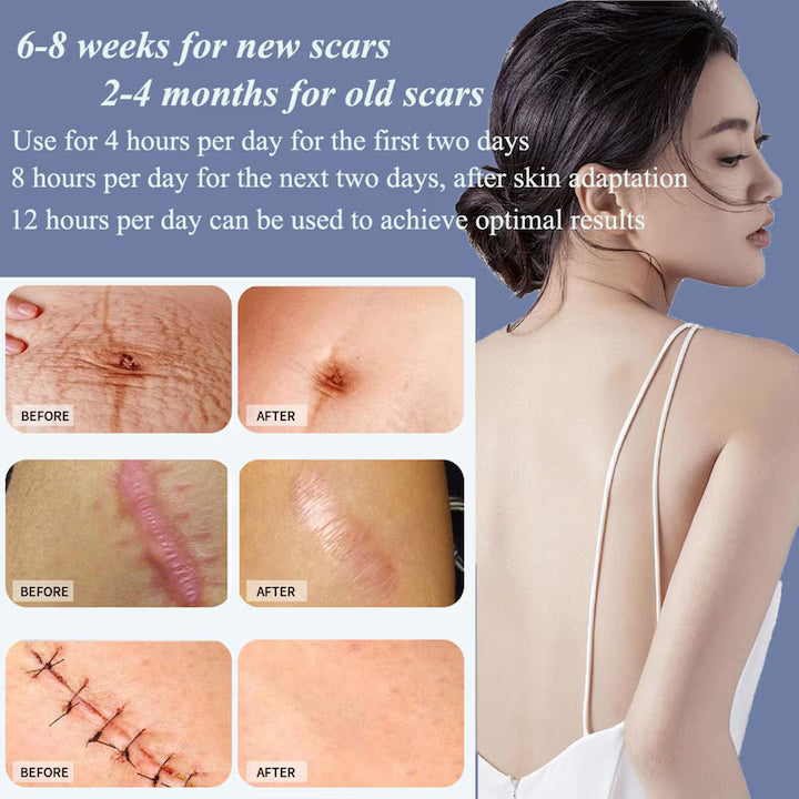 Hons Medical Silicone scar sheet ( BUY 1 GET 1 FREE )