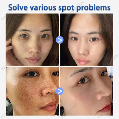 ✨ Whitening Dark Spot Remover Cream ✨ ( BUY 1 GET 1 FREE )