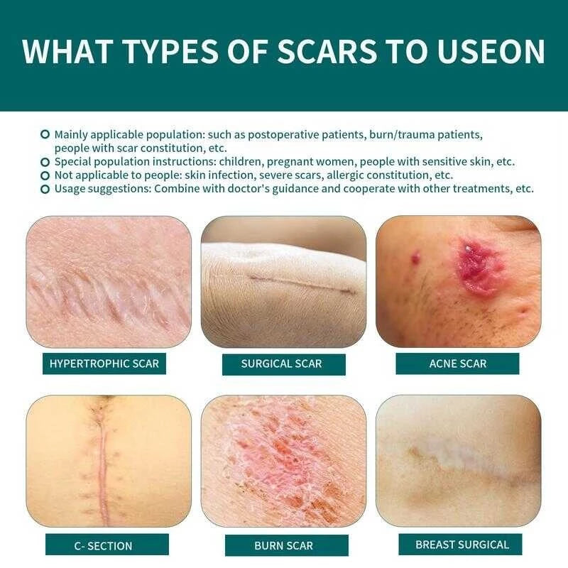 ✨🩹 Qustere Silicone Scar Sheet 🩹✨ ( BUY 1 GET 1 FREE )